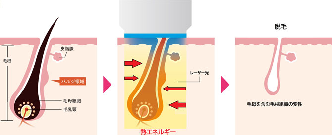レーザー脱毛の原理