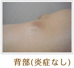 背部(炎症なし)
