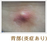 背部(炎症あり)