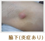 脇下(炎症あり)