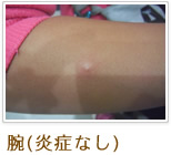 腕(炎症なし)