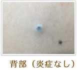 背部(炎症なし)